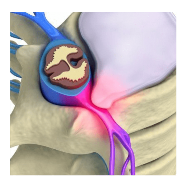 Hernia Cervical Imagem ilustrativa de Hernia Cervical