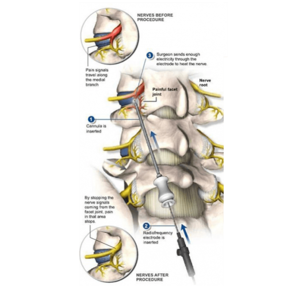 Rizotomia Imagem Ilustrativa de Rizotomia