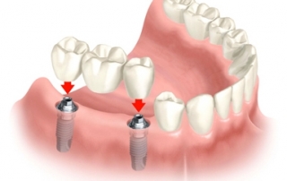 Imagem ilustrativa procedimento odontologico