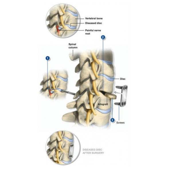 Ava Cervical Imagem Ilustrativa de Ava Cervical