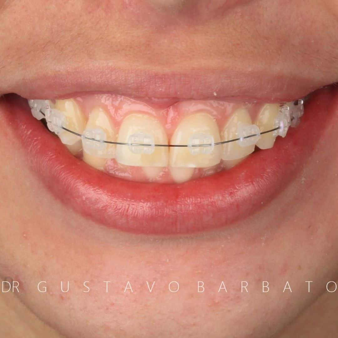 Ortodontia Especializada - Trabalho 01 - Única Odontologia