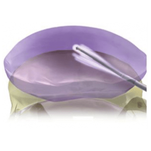 Nucleoplastia Imagem ilustrativa de Nucleoplastia