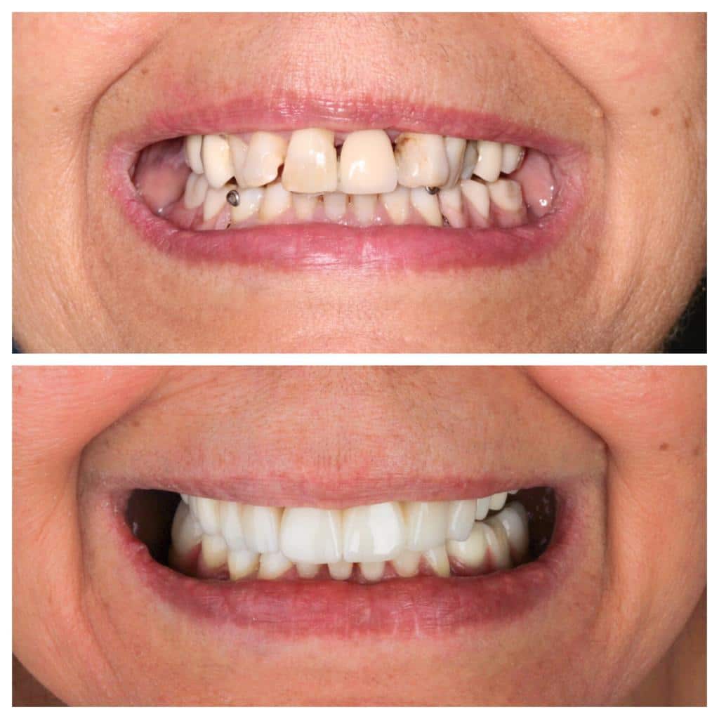 Reabilitação Oral - Trabalho 02 - Única Odontologia