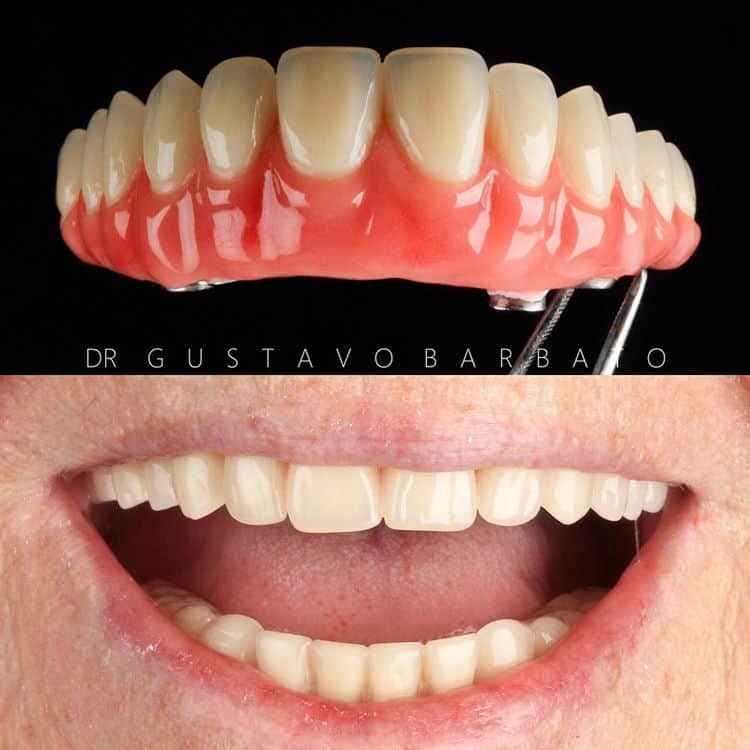 Prótese Fixa ou Removível - Trabalho 03 - Única Odontologia